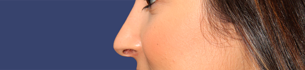 After rhinoplasty surgery