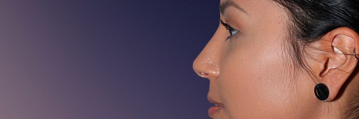 Female patient after rhinoplasty surgery