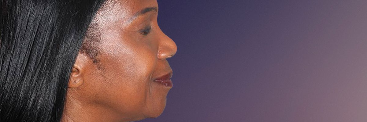 African American rhinoplasty in Toronto - Before
