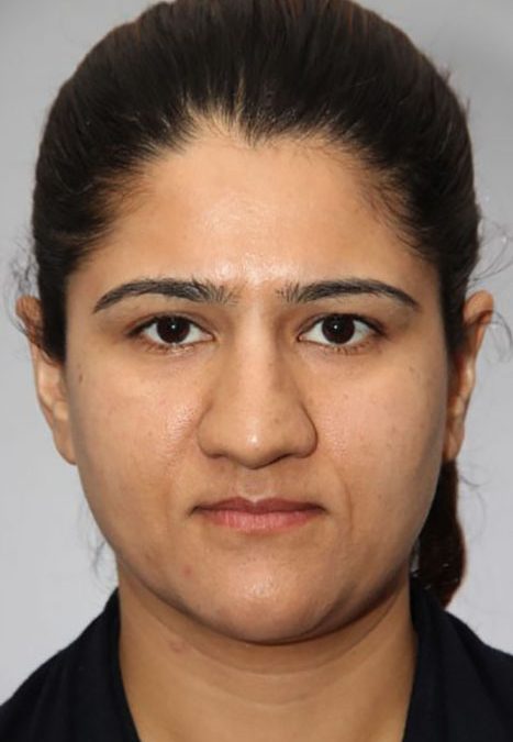 Female patient after alar reduction
