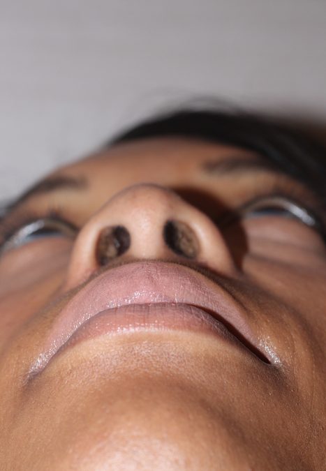 Female patient after alar reduction