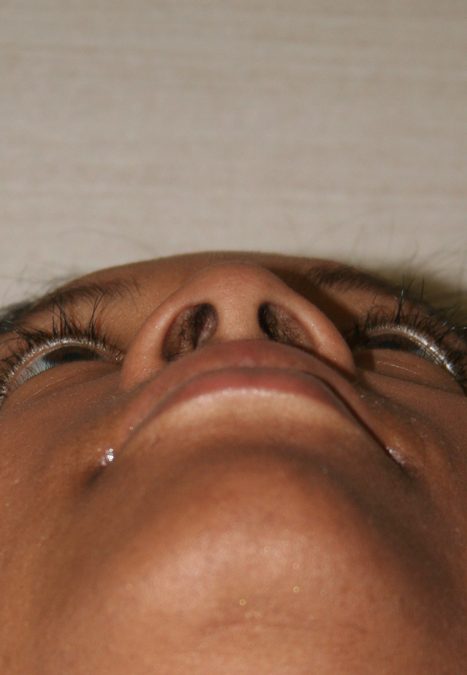 Female patient after alar reduction