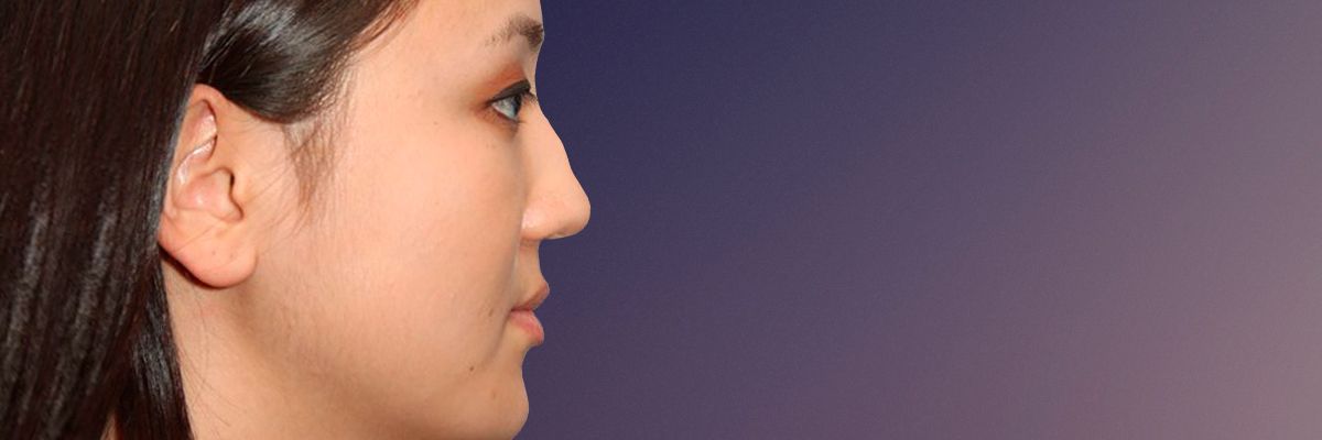 Asian patient before rhinoplasty