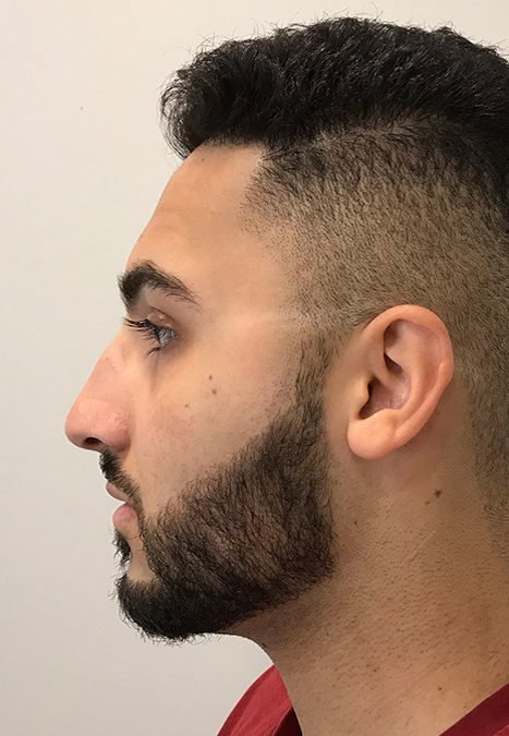 Male patient before injectable rhinoplasty