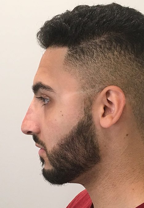 Male patient after injectable rhinoplasty