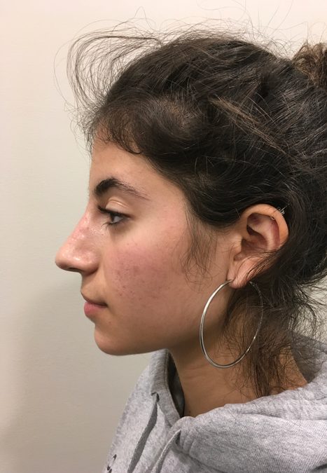 Female patient after injectable rhinoplasty