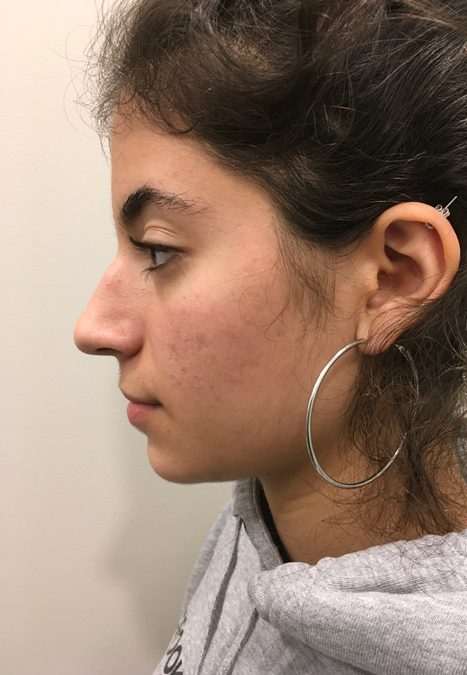 Female patient before injectable rhinoplasty