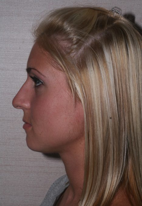 Female patient before nasal tip