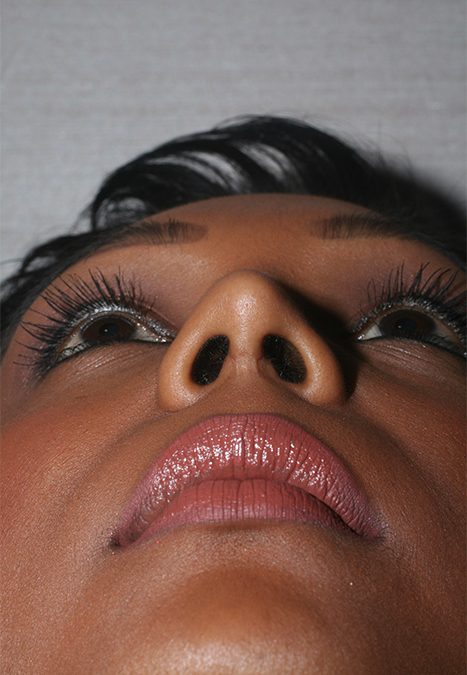 Female patient after nasal tip