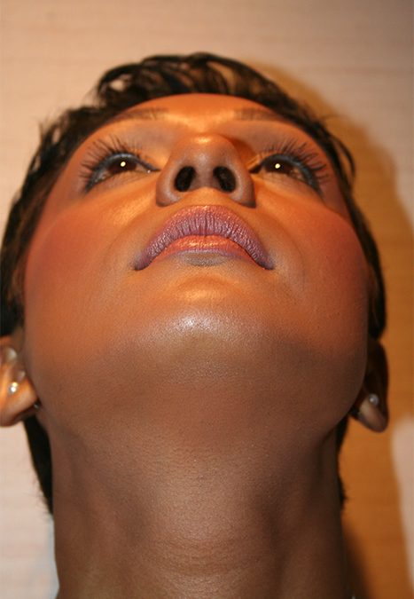 Female patient before nasal tip