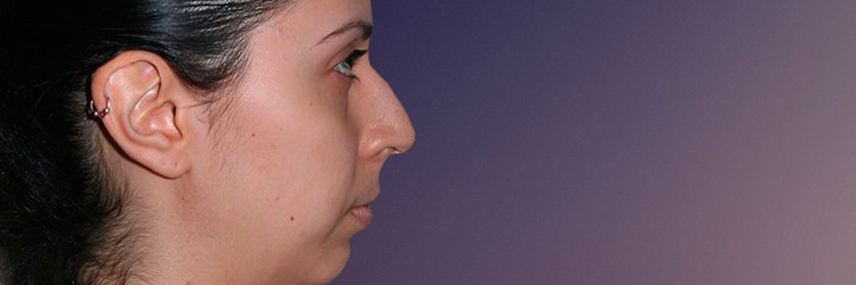 Persian patient before rhinoplasty