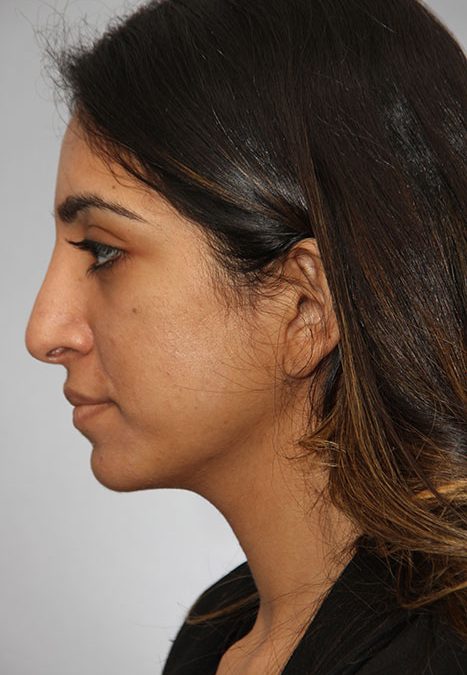Female patient after reconstructive septorhinoplasty