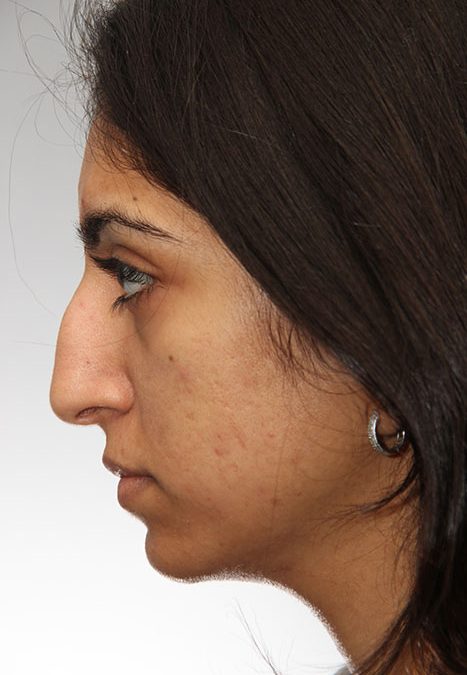 Female patient before reconstructive septorhinoplasty