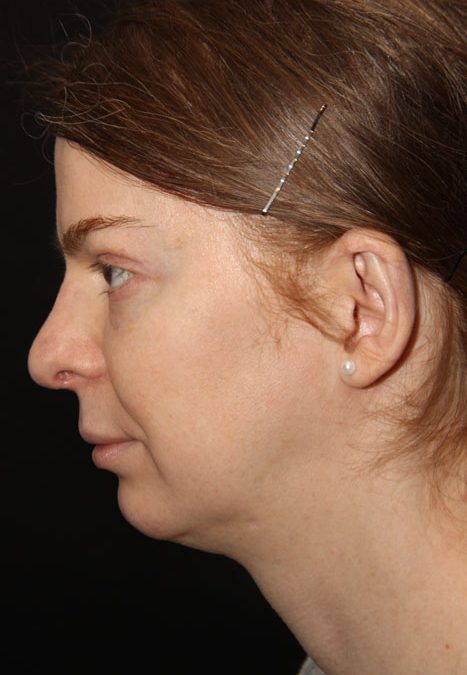Female patient after revision rhinoplasty