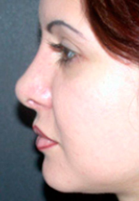 Female patient after revision rhinoplasty