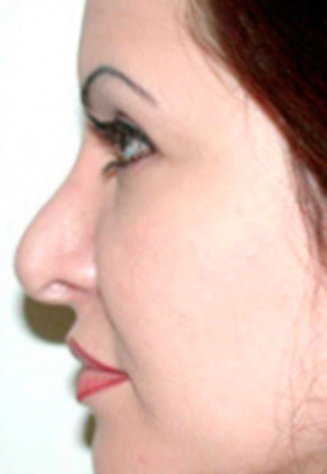 Female patient before revision rhinoplasty