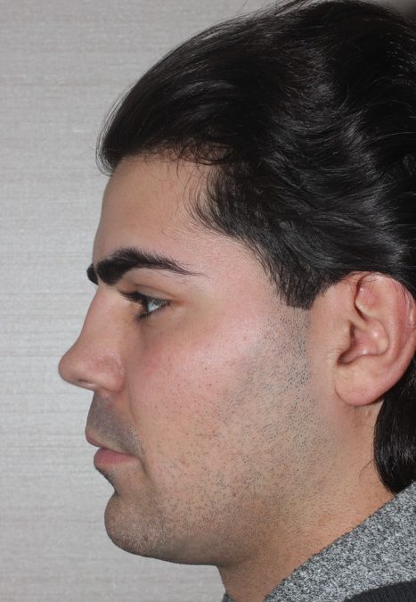Male patient before revision rhinoplasty