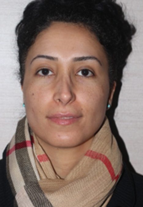 Female patient before revision rhinoplasty