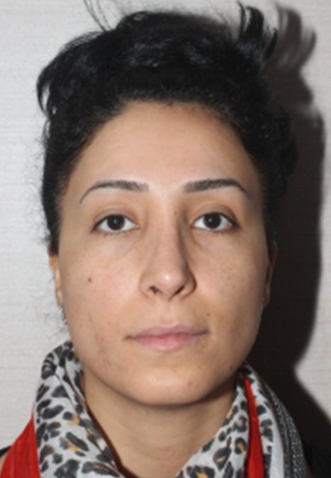 Female patient after revision rhinoplasty