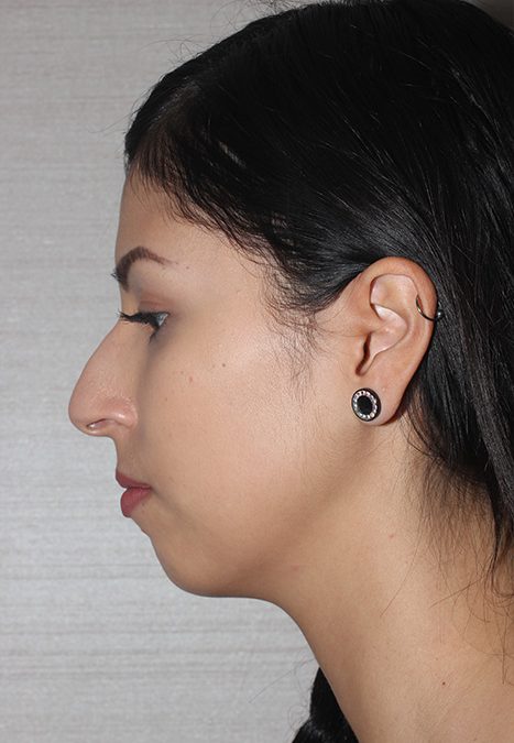 Female patient before rhino chin implant