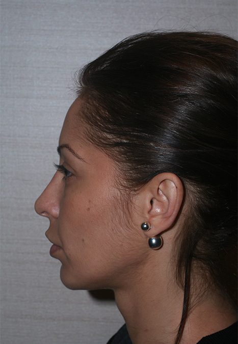 Female patient after rhino chin implant