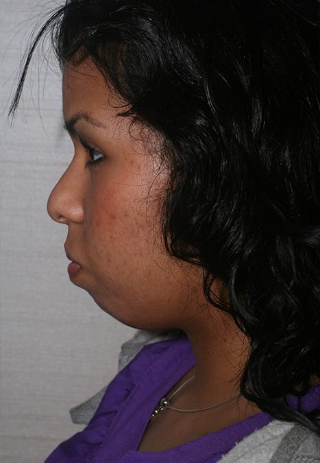 Female patient before rhino chin implant