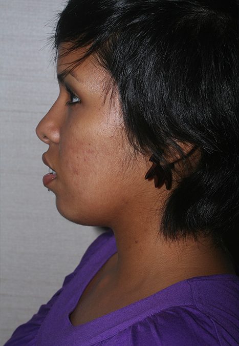 Female patient after rhino chin implant