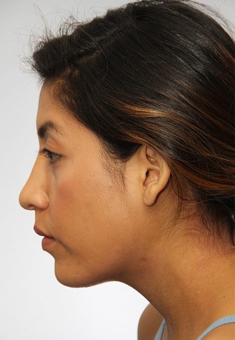 Female patient after rhino chin implant