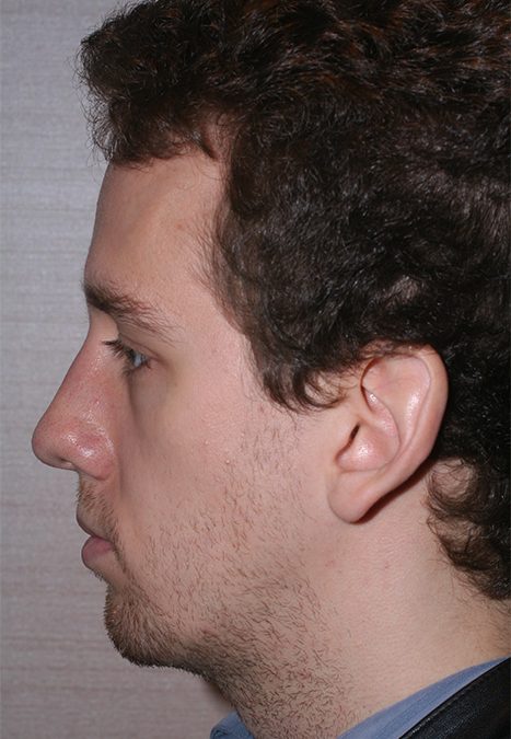 Male patient after rhino chin implant