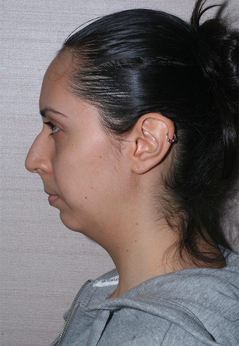 Female patient before rhino chin implant