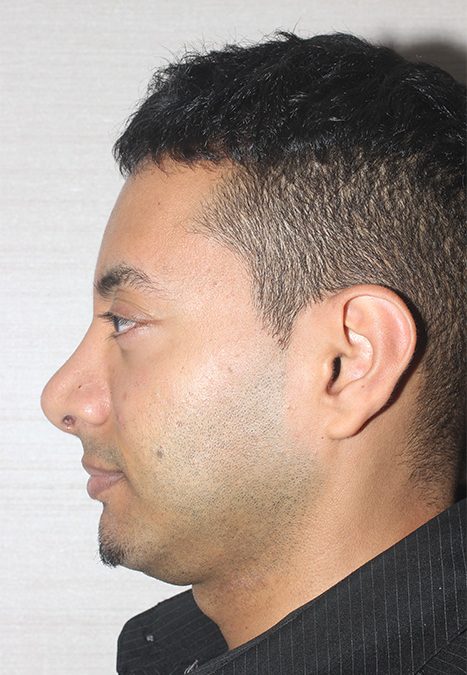 Male patient before rhino chin implant