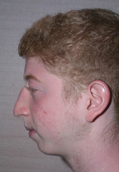Male patient before rhino chin implant