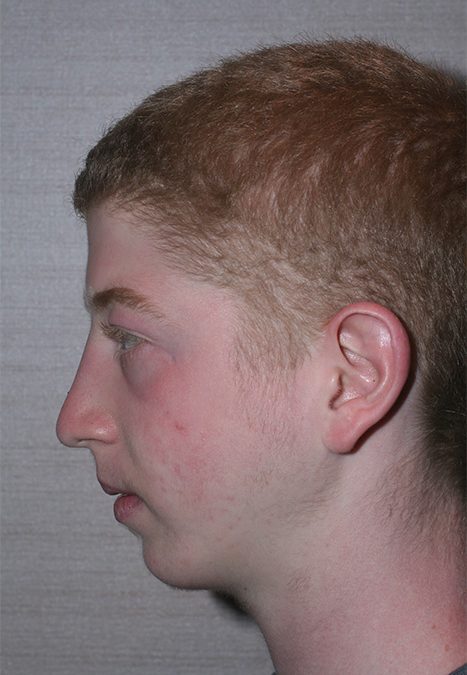 Male patient after rhino chin implant