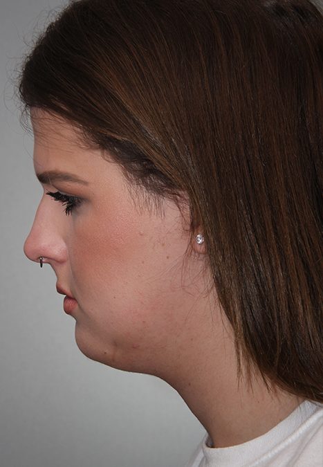 Transgender patient before Transgender Rhinoplasty