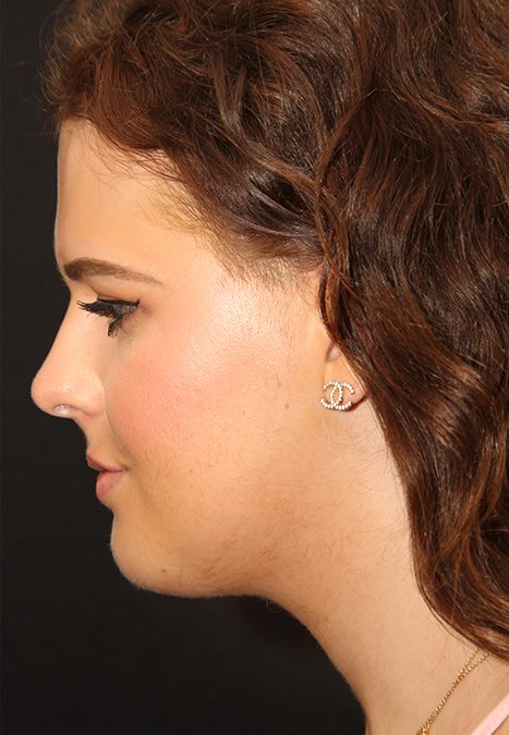 Transgender patient after Transgender Rhinoplasty