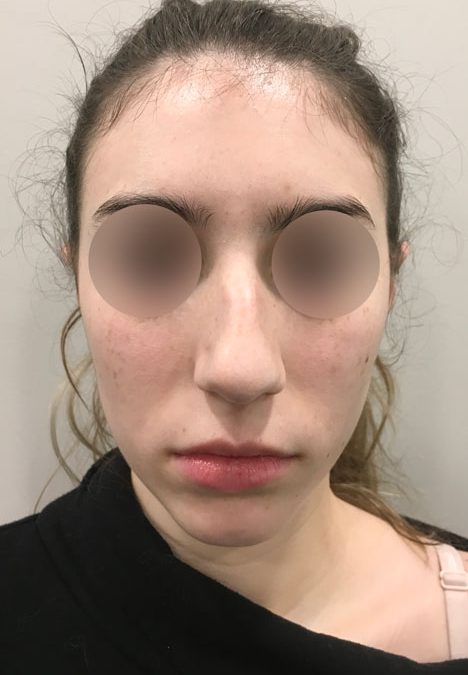 Female patient before injectable rhinoplasty