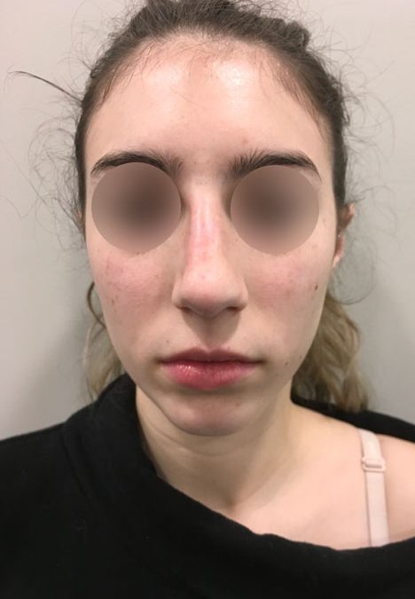 Female patient after injectable rhinoplasty