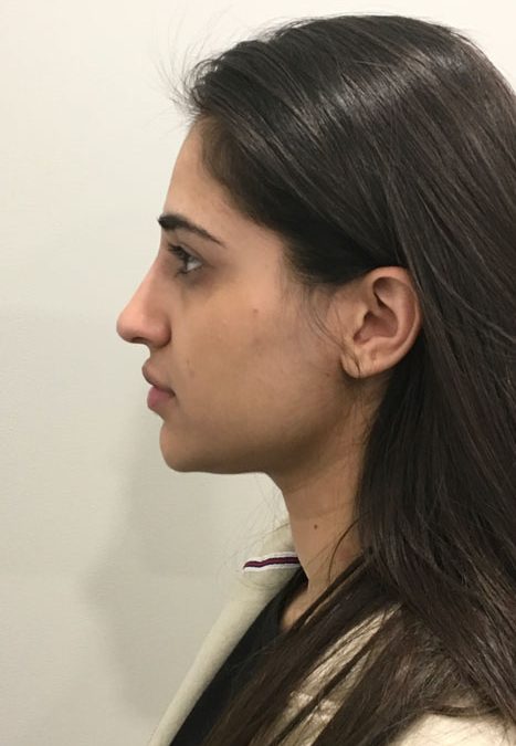 Female patient after injectable rhinoplasty