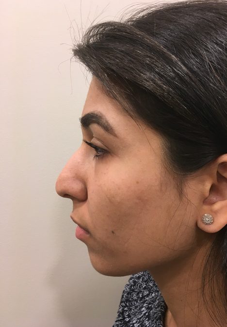 Female patient before injectable rhinoplasty
