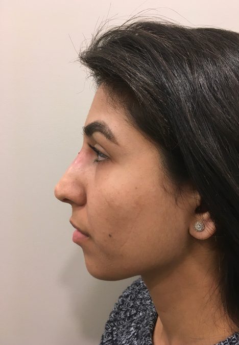 Female patient after injectable rhinoplasty