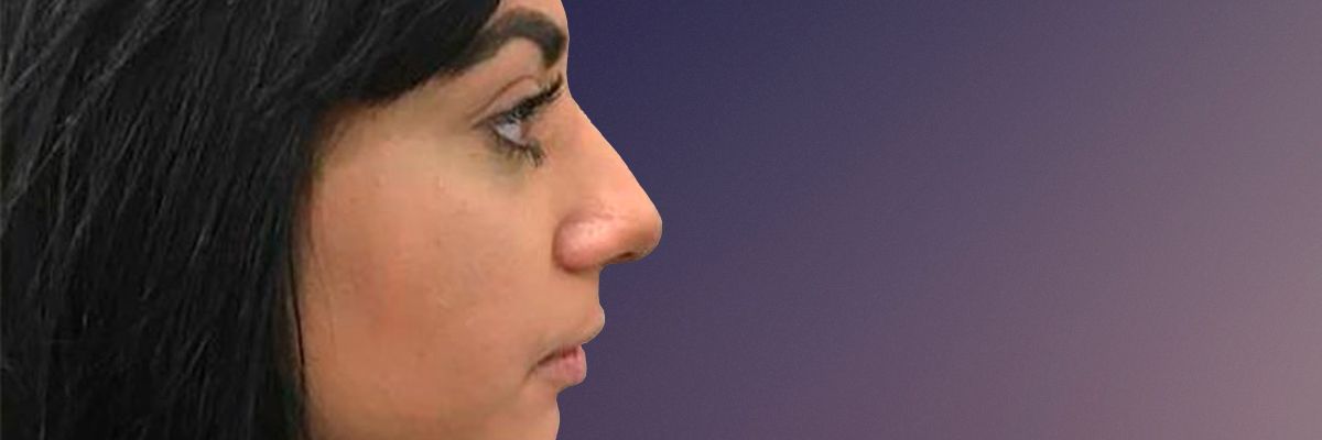Before rhinoplasty surgery