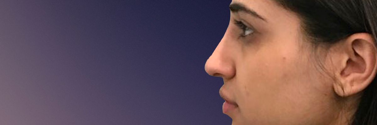 After rhinoplasty surgery