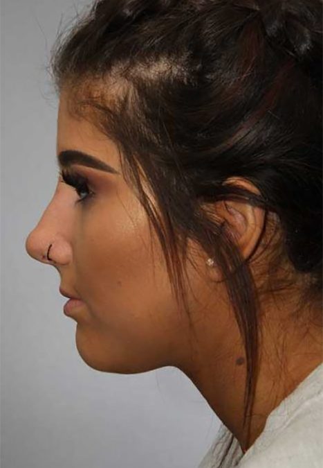 Female patient after injectable rhinoplasty