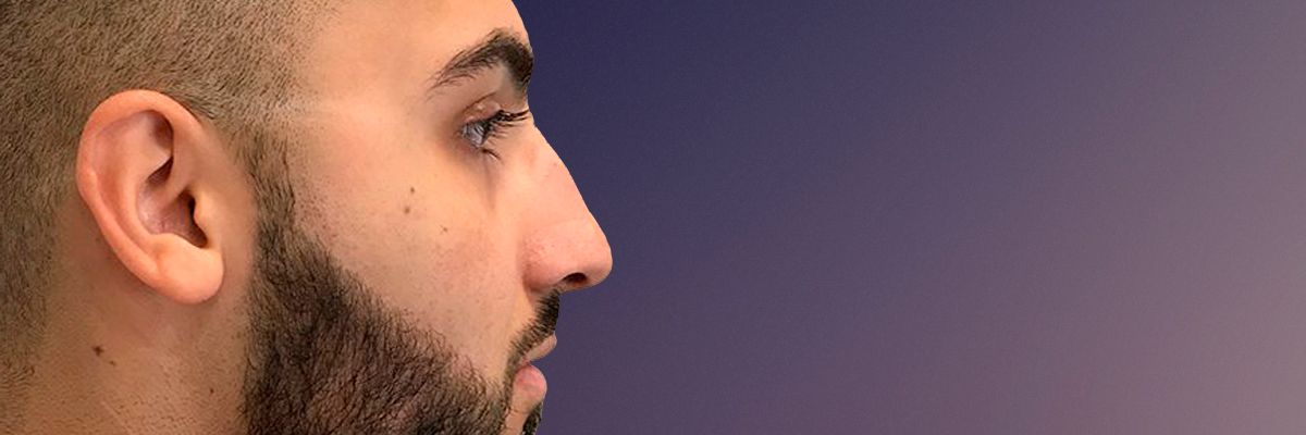 Male before rhinoplasty surgery