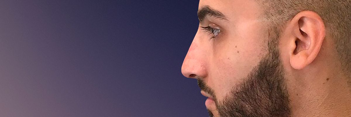 Male after rhinoplasty surgery