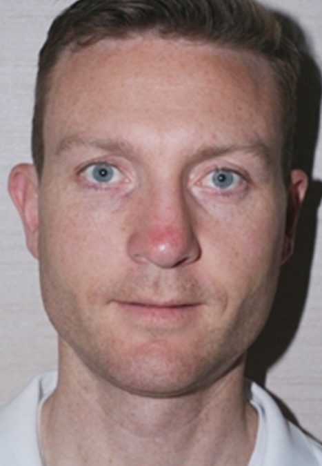 Male patient after nasal tip