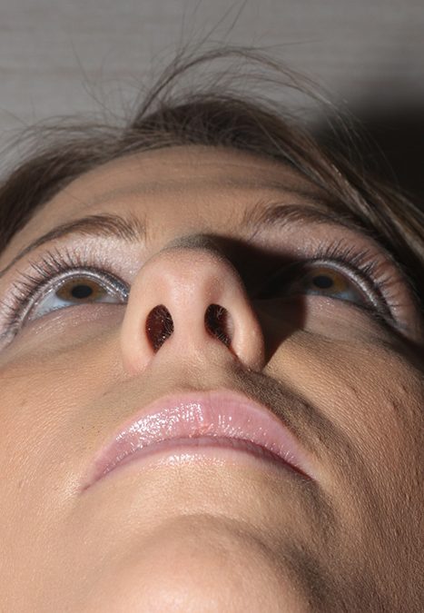 Female patient before nasal tip