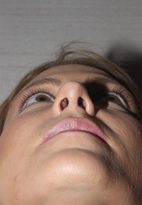Female patient after nasal tip