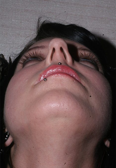 Female patient before nasal tip