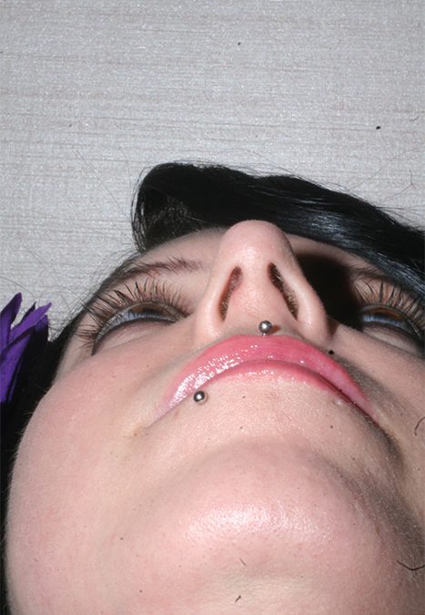 Female patient after nasal tip